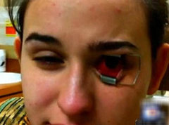 lensteki kurt gozunu yedi