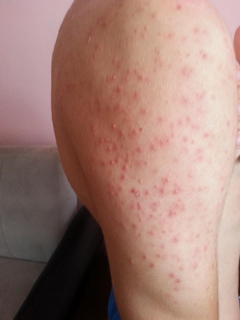 denize gittim omuz sirt bu hale geldi ssli