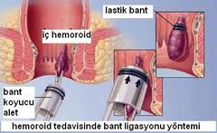  Hemoroid (Basur) Çeşitli Tedavi Yöntemleri