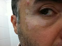 vitiligo geçmeye başladı