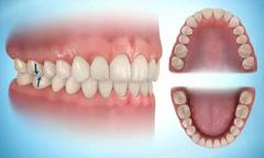 Alt üst dişlerin tam birleşmesi sağlıklı mı ?