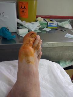  Tırnak çekimi/ameliyatı sonrası ayakkabı