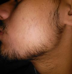 Minoxil sakal serumu işe yarar mı bu sakala (ss) | DonanımHaber Forum