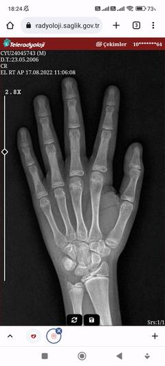Arkadaşlar boyum 171 beş ay önce doktora gittim bu röntgeni çekti kemik yaşın 13.5 dedu kaç olurum