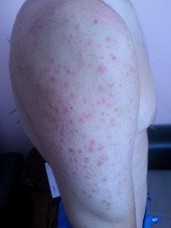 denize gittim omuz sirt bu hale geldi ssli