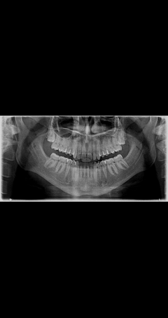Diş Panoramik Röntgen 20lik Diş