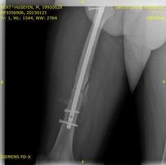  bacak kırılması (femur kırıgı)