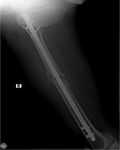  bacak kırılması (femur kırıgı)