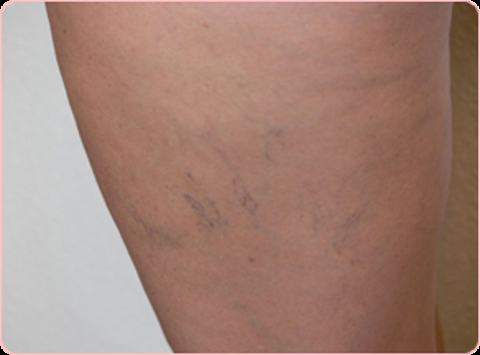 ---KIRMIZI NOKTALAR ÇIKMAYA BAŞLADI---