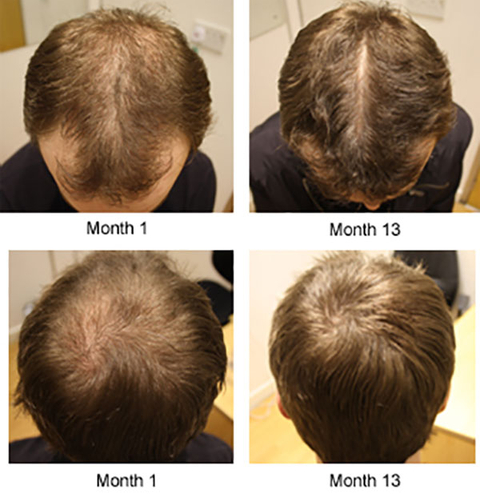 (Ss’li) Dökülen Saçlarım yeniden Çıktı