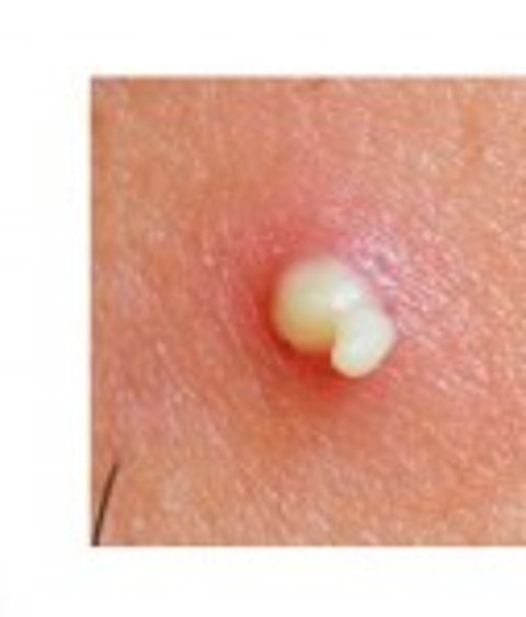 Beyaz Sivilce Problemi