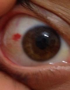  Darbe sonrası göz sklerasında kanlı leke (SS'li)
