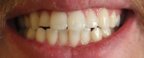 14 Günlük Diş Beyazlatma Konusu (Crest 3D Strips)6.Gün Eklendi