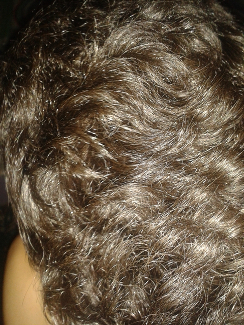 16 YAŞINDAYIM SAÇIM YAN TARAFI DÖKÜLDÜ