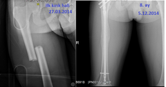  bacak kırılması (femur kırıgı)