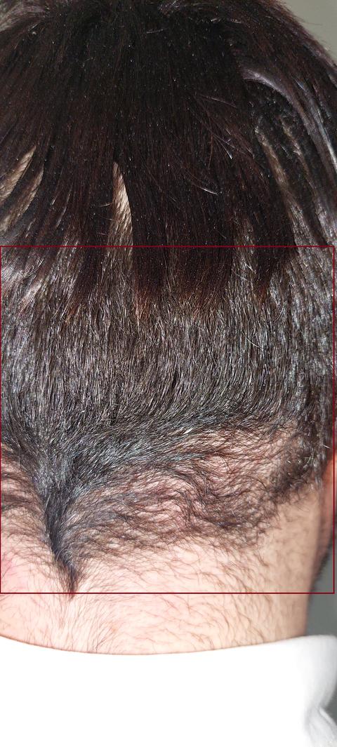  Protez Saç Hakkında (Saç Ektirmek İsteyenlere)