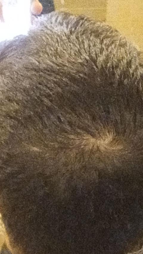 Saç dökülmesi nasıl önlenir