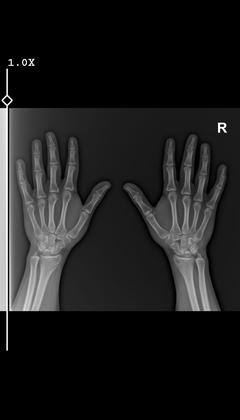 Boy uzaması sol el röntgenim