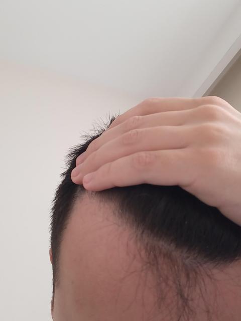 Saçımın önleri açılmaya başladı