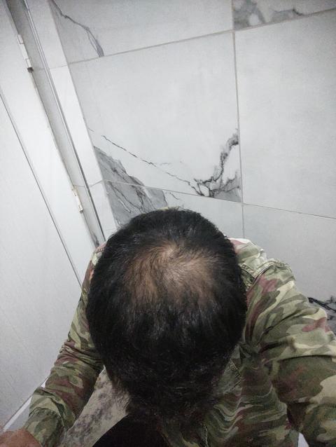 Saç dökülmesi