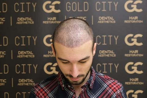 Gold City Hair | Saç Ekimi 6.Ay 5000 Greft