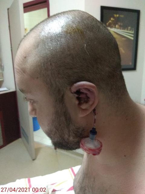 Kulak Onarım Ameliyatı Oldum [SS'li]