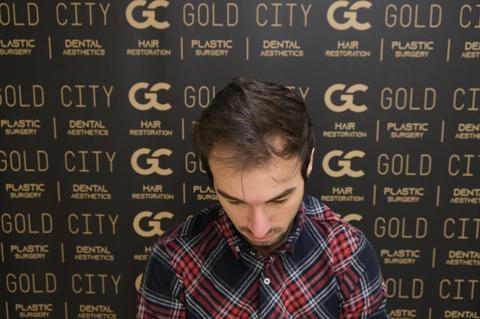 Gold City Hair | Saç Ekimi 6.Ay 5000 Greft