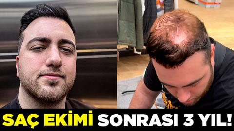 SAÇ EKİMİ SONUÇLARI