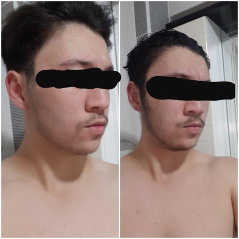 3 aylık Minoksil(saç-sakal çıkarıcı ilaç) kullanımım