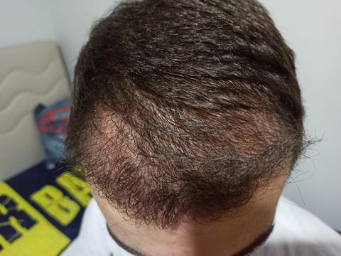 Gold City Hair | Saç Ekimi 6.Ay 5000 Greft