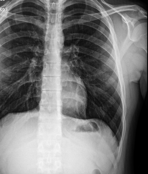 Röntgen tomografi sonuçlarım iyi mi?