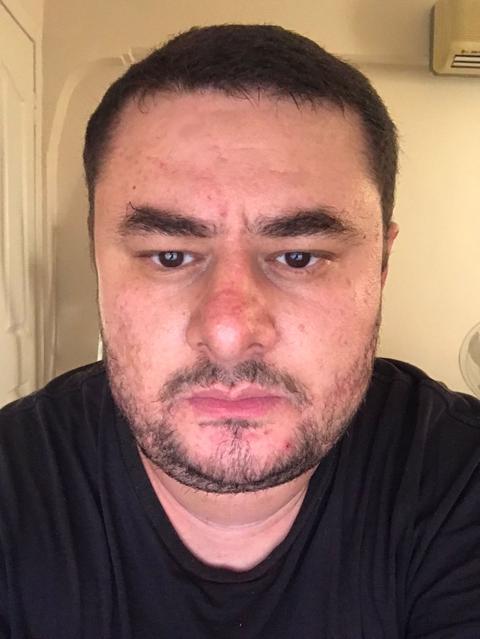 Alnımdaki ben'i aldırayım mı? ne diyonuz?