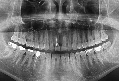 Dişten anlayanlar bakabilir mi? (radyolojik görüntü)