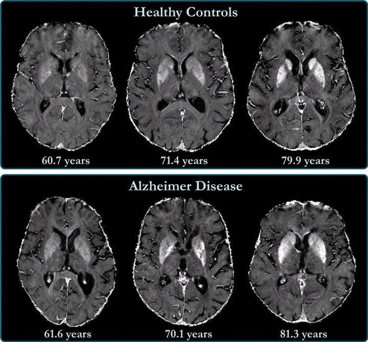 Alzheimer prognozu ile beyindeki demir birikimi arasında korelasyon tespit edildi