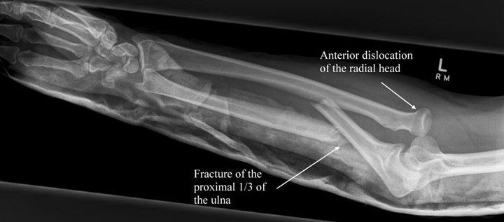 Yeni implant kemik onarımını hızlandırabilir